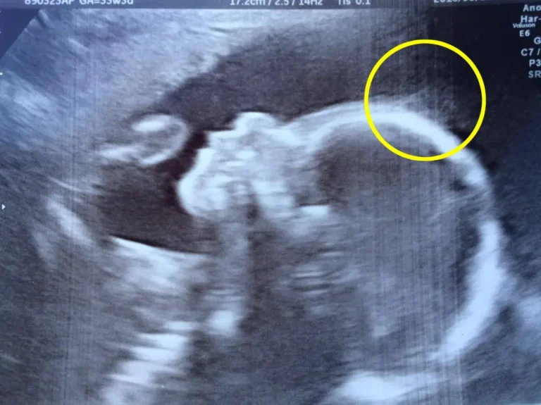 Lors de l’échographie, les médecins ont été interloqués. À sa naissance, cette petite fille a ému le monde par sa résilience et sa grâce.